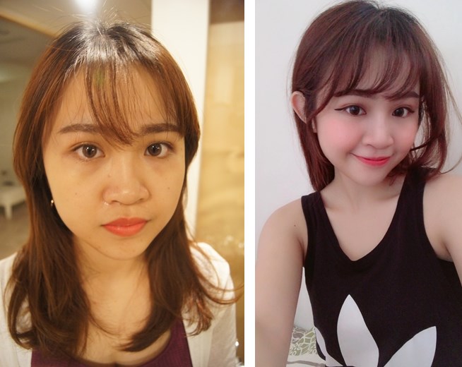 嘉義醫美診所 技術最好的哪裡找 推薦整形外科肉毒微整 玻尿酸微整型權威醫師 Beautytoday美麗線上 台灣