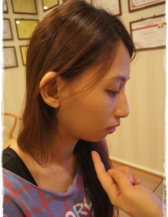 嘉義音波拉皮