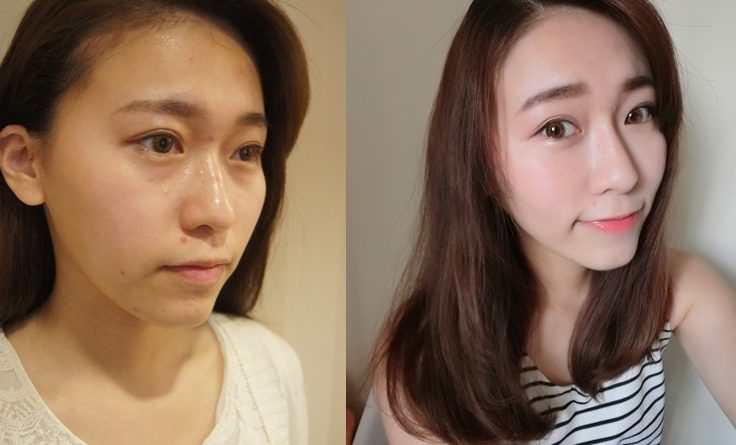 基隆肉毒