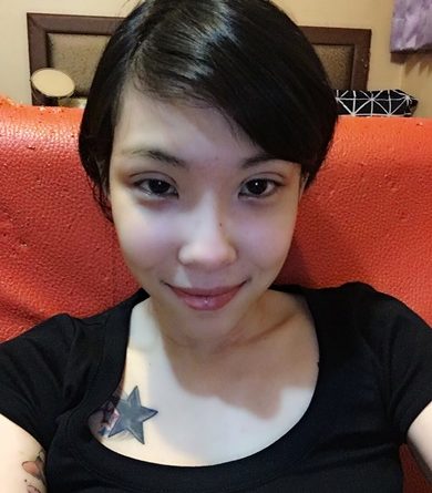 宜蘭割雙眼皮
