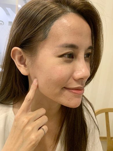 肉毒瘦小 肉毒瘦小