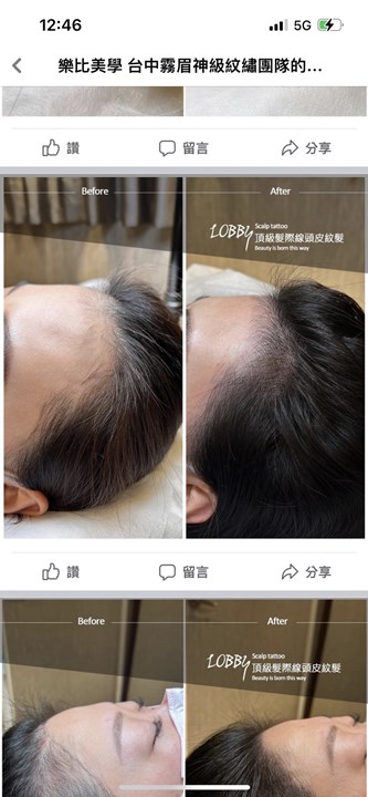 新北頭皮紋髮-版權所有(樂比美學) 新北髮際線推薦-版權所有(樂比美學)